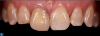 Fig. 1 The patient presented with a 40-year-old feldspathic crown (tooth No. 8) that no longer matched the shade of her natural teeth, as well as a displaced composite restoration on tooth No. 7. Teeth Nos. 7, 9, and 10 were found to have some interproximal lesions (class III caries).