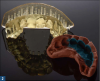 Fig 2. The digital design can be 3D printed in order to create a putty matrix to be used for provisionalization.