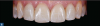 Fig 6. The treatment outcome: whitening and e.max-pressed 
anterior restorations. Having been fully involved throughout the process, the patient was highly satisfied with the result.